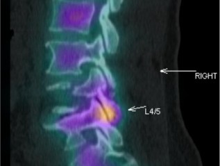 Facet joint treatments