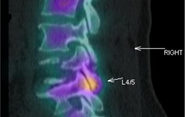 Facet joint treatments